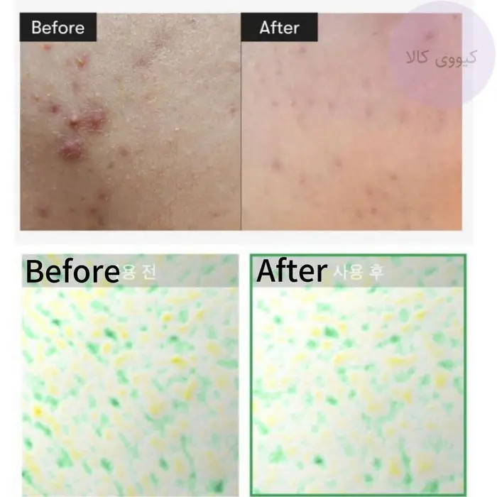 سرم میکرونیدلینگ ریدل شات اصلی کره ای